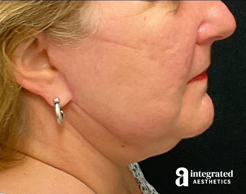 Facelift & Neck Lift Before & After Gallery - Patient 133212791 - Image 10