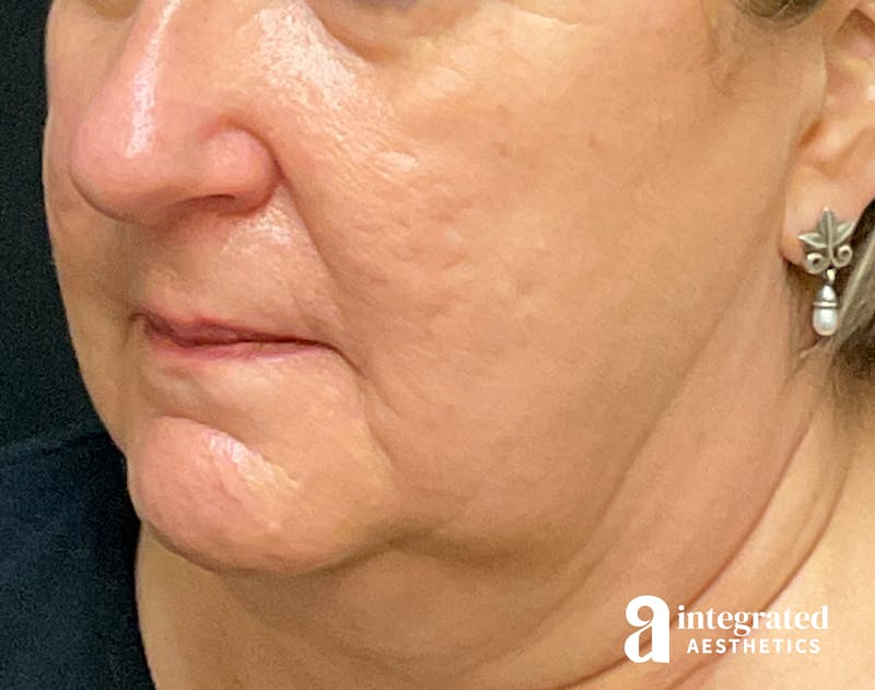 Facelift & Neck Lift Before & After Gallery - Patient 133212791 - Image 5