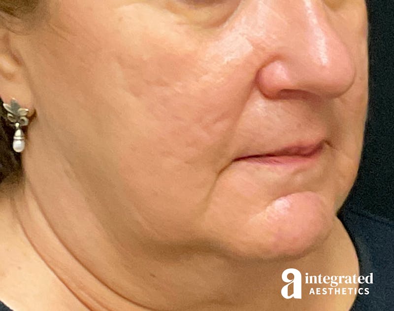 Facelift & Neck Lift Before & After Gallery - Patient 133212791 - Image 1