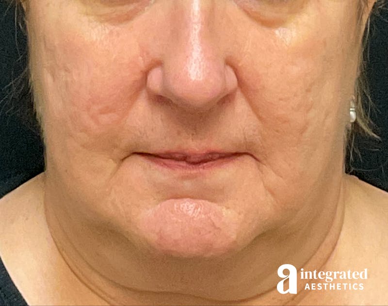 Facelift & Neck Lift Before & After Gallery - Patient 133212791 - Image 3