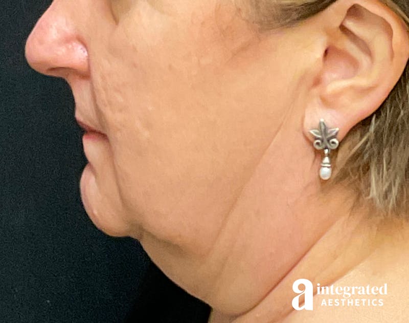 Facelift & Neck Lift Before & After Gallery - Patient 133212791 - Image 7