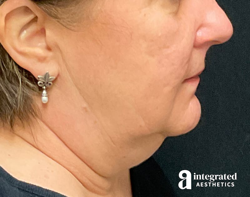 Facelift & Neck Lift Before & After Gallery - Patient 133212791 - Image 9