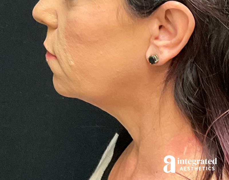 Facelift & Neck Lift Before & After Gallery - Patient 133212814 - Image 5