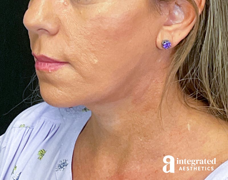 Facelift & Neck Lift Before & After Gallery - Patient 133212814 - Image 8