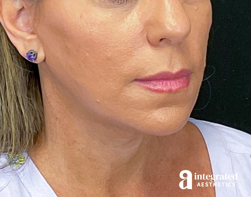 Facelift & Neck Lift Before & After Gallery - Patient 133212814 - Image 2