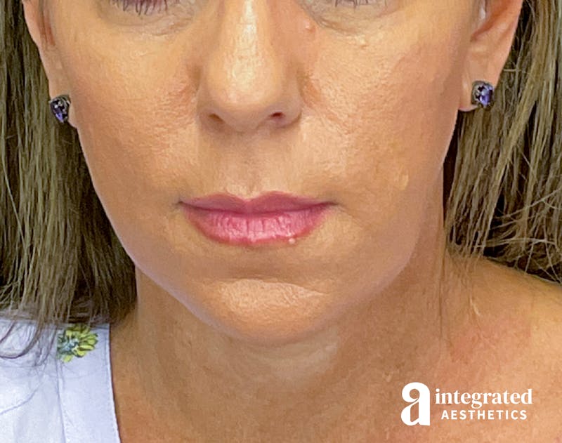 Facelift & Neck Lift Before & After Gallery - Patient 133212814 - Image 4