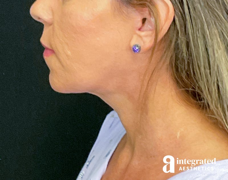 Facelift & Neck Lift Before & After Gallery - Patient 133212814 - Image 6