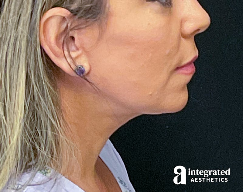 Facelift & Neck Lift Before & After Gallery - Patient 133212814 - Image 10