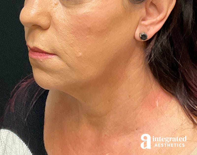 Facelift & Neck Lift Before & After Gallery - Patient 133212814 - Image 7