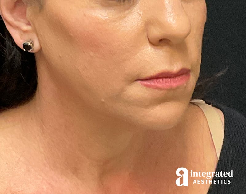 Facelift & Neck Lift Before & After Gallery - Patient 133212814 - Image 1