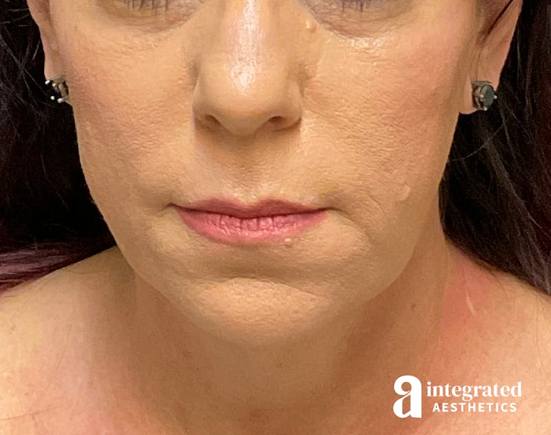 Facelift & Neck Lift Before & After Gallery - Patient 133212814 - Image 3