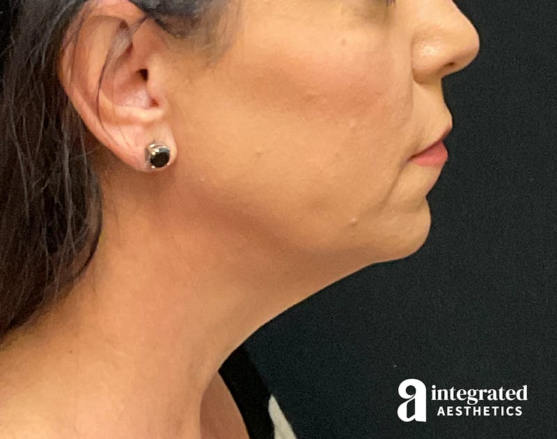 Facelift & Neck Lift Before & After Gallery - Patient 133212814 - Image 9