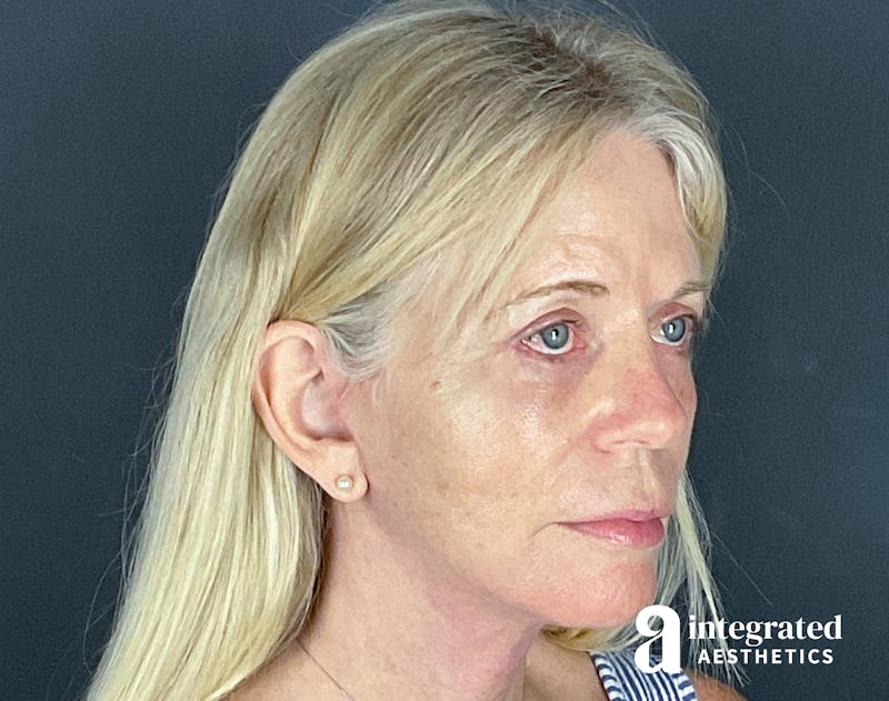 Facelift & Neck Lift Before & After Gallery - Patient 133212829 - Image 2