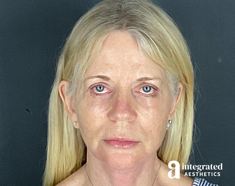 Facelift & Neck Lift Before & After Gallery - Patient 133212829 - Image 6