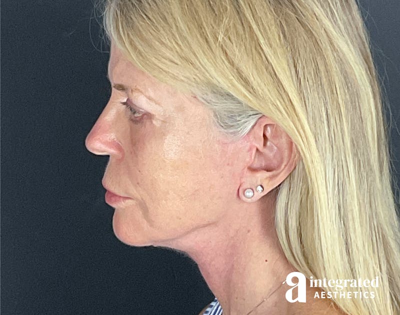 Facelift & Neck Lift Before & After Gallery - Patient 133212829 - Image 8