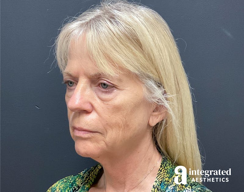 Facelift & Neck Lift Before & After Gallery - Patient 133212829 - Image 3