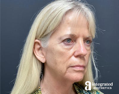 Facelift & Neck Lift Before & After Gallery - Patient 133212829 - Image 1