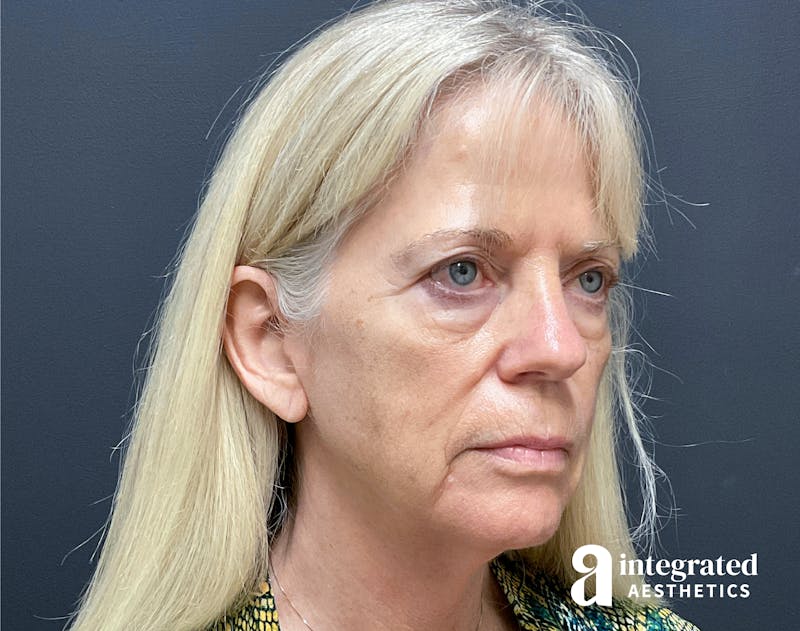 Facelift & Neck Lift Before & After Gallery - Patient 133212829 - Image 1