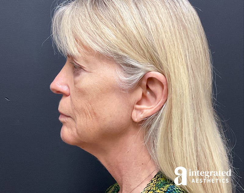 Facelift & Neck Lift Before & After Gallery - Patient 133212829 - Image 7