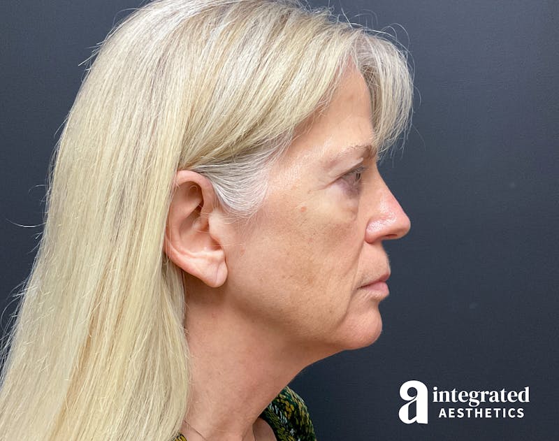 Facelift & Neck Lift Before & After Gallery - Patient 133212829 - Image 9