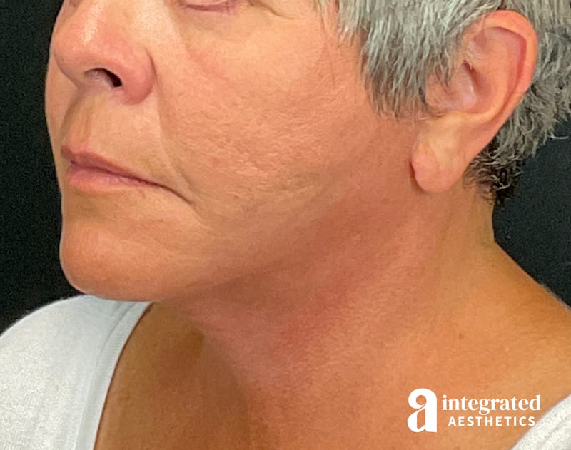 Facelift & Neck Lift Before & After Gallery - Patient 133212854 - Image 6