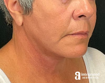 Facelift & Neck Lift Before & After Gallery - Patient 133212854 - Image 2