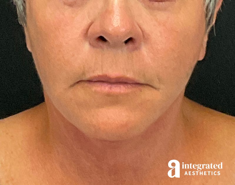 Facelift & Neck Lift Before & After Gallery - Patient 133212854 - Image 4