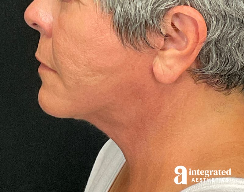Facelift & Neck Lift Before & After Gallery - Patient 133212854 - Image 8