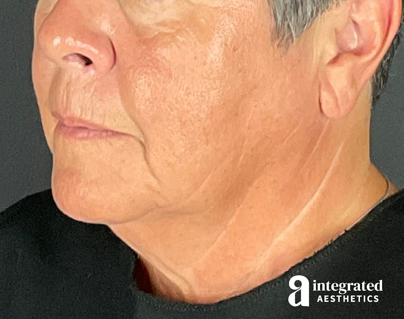 Facelift & Neck Lift Before & After Gallery - Patient 133212854 - Image 5