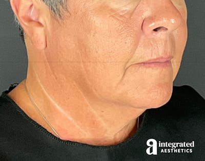Facelift & Neck Lift Before & After Gallery - Patient 133212854 - Image 1