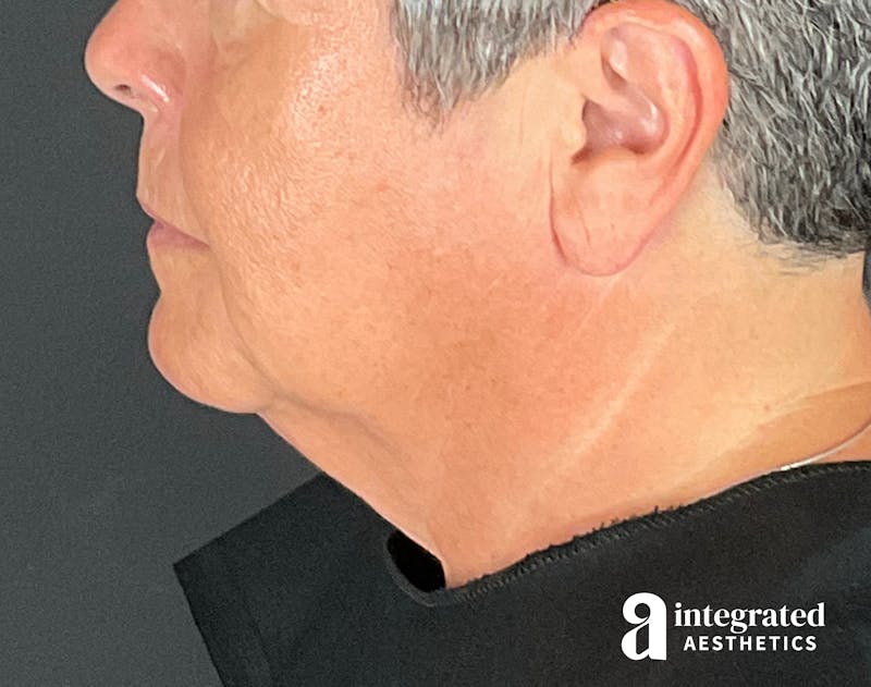 Facelift & Neck Lift Before & After Gallery - Patient 133212854 - Image 7