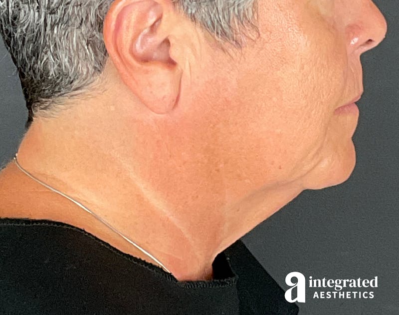 Facelift & Neck Lift Before & After Gallery - Patient 133212854 - Image 9
