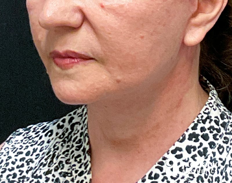 Facelift & Neck Lift Before & After Gallery - Patient 133212866 - Image 6