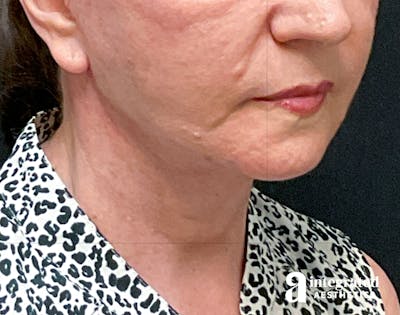 Facelift & Neck Lift Before & After Gallery - Patient 133212866 - Image 2