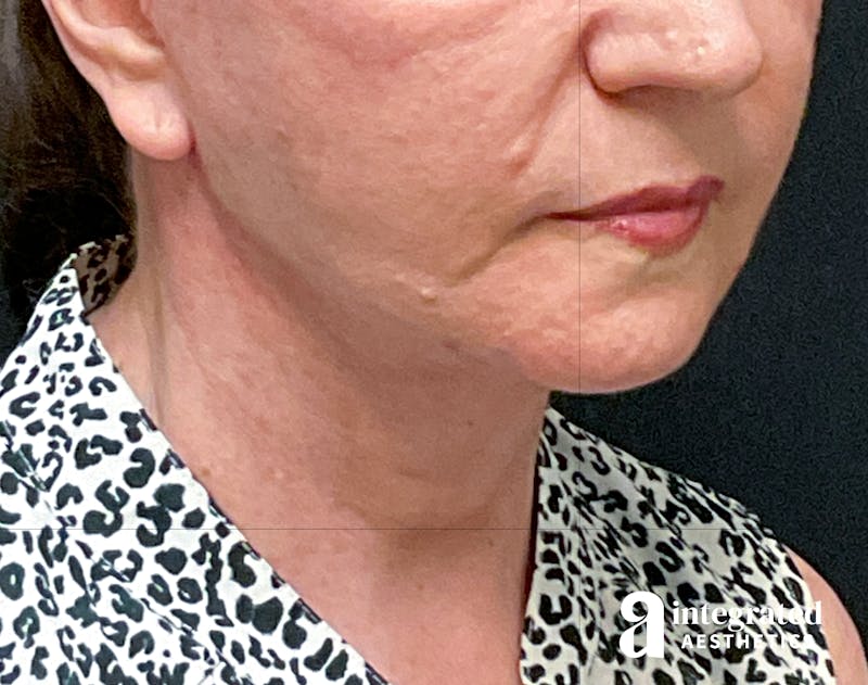 Facelift & Neck Lift Before & After Gallery - Patient 133212866 - Image 2