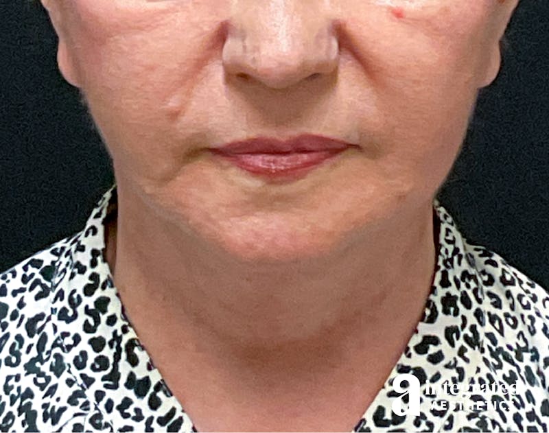 Facelift & Neck Lift Before & After Gallery - Patient 133212866 - Image 4