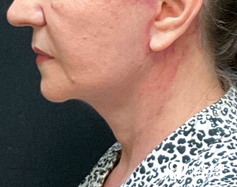 Facelift & Neck Lift Before & After Gallery - Patient 133212866 - Image 8