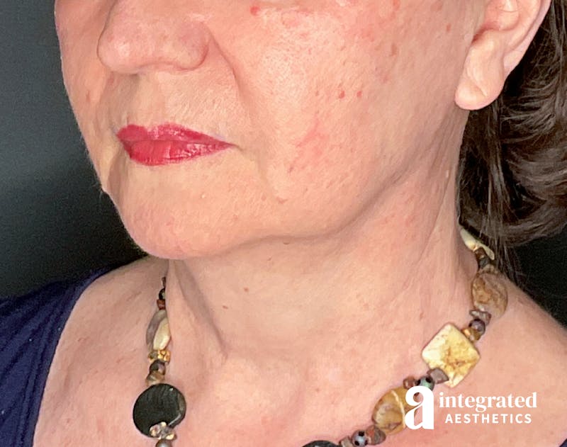 Facelift & Neck Lift Before & After Gallery - Patient 133212866 - Image 5