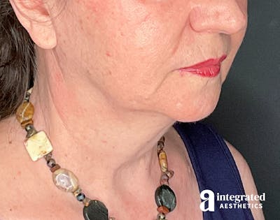 Facelift & Neck Lift Before & After Gallery - Patient 133212866 - Image 1