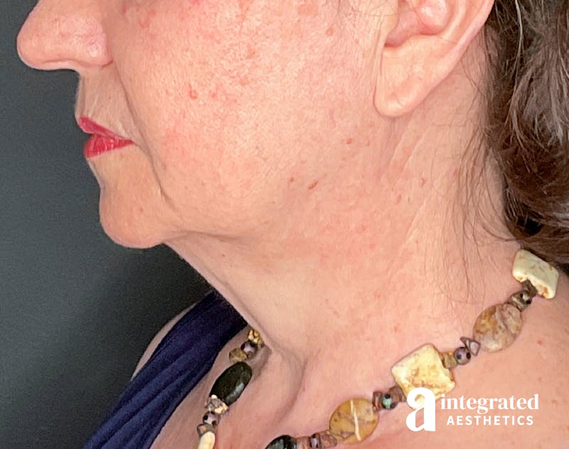 Facelift & Neck Lift Before & After Gallery - Patient 133212866 - Image 7