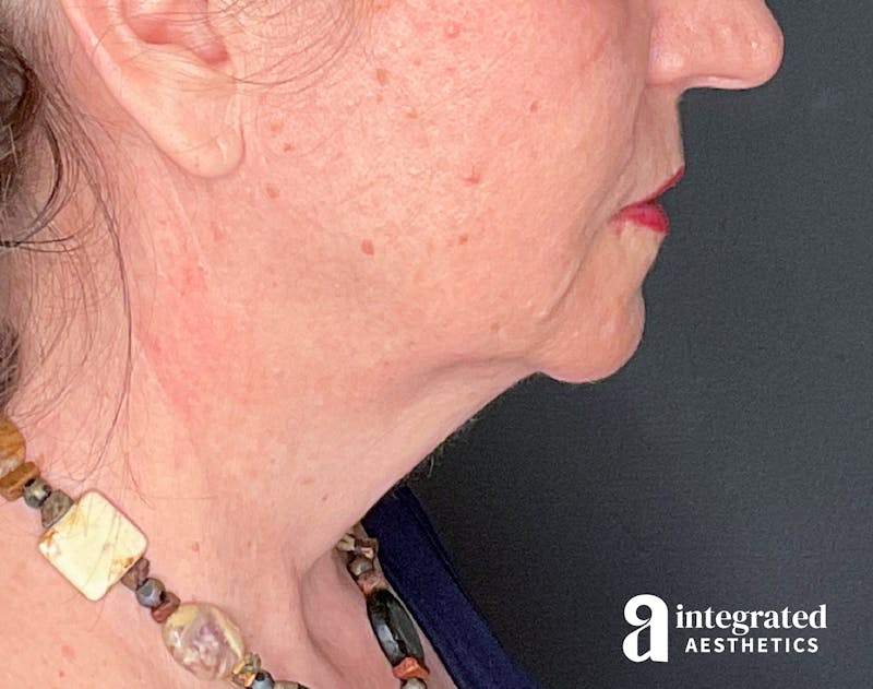 Facelift & Neck Lift Before & After Gallery - Patient 133212866 - Image 9
