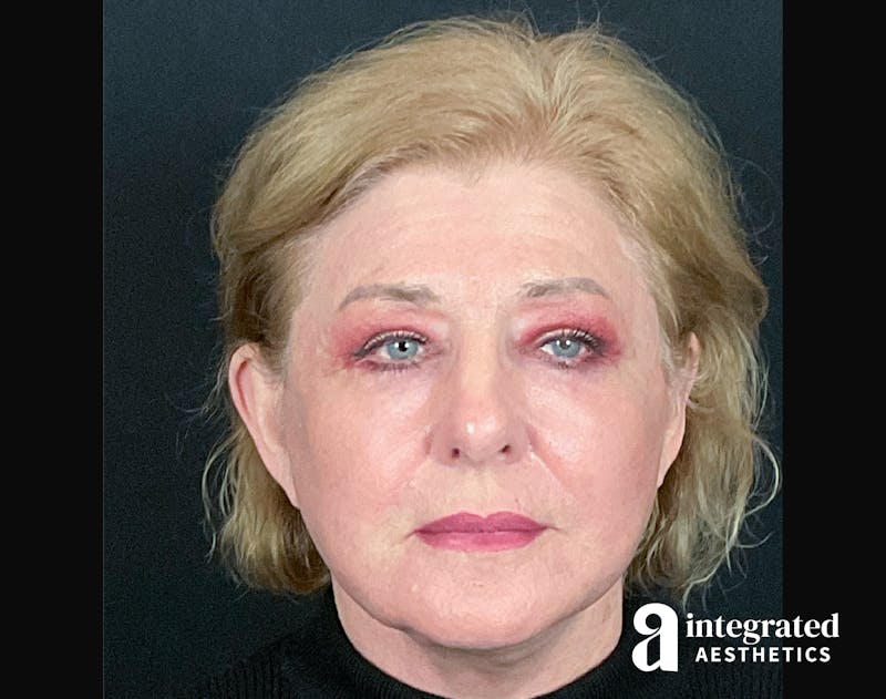 Facelift & Neck Lift Before & After Gallery - Patient 133212879 - Image 4