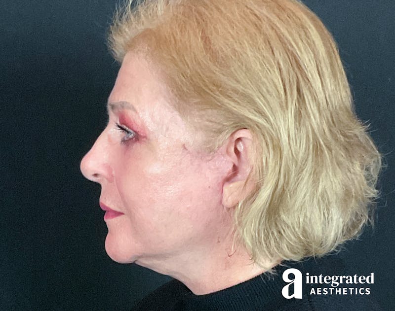 Facelift & Neck Lift Before & After Gallery - Patient 133212879 - Image 8