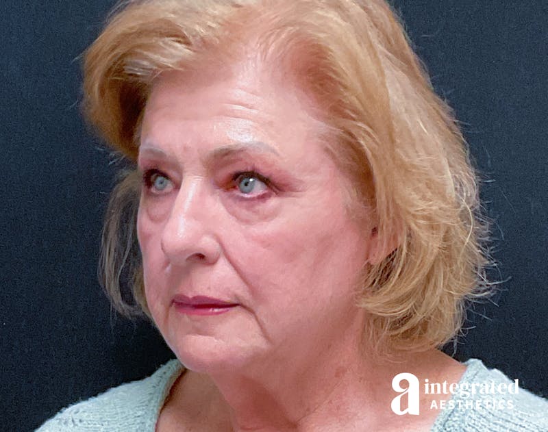 Facelift & Neck Lift Before & After Gallery - Patient 133212879 - Image 5