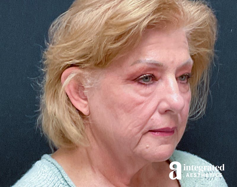 Facelift & Neck Lift Before & After Gallery - Patient 133212879 - Image 1