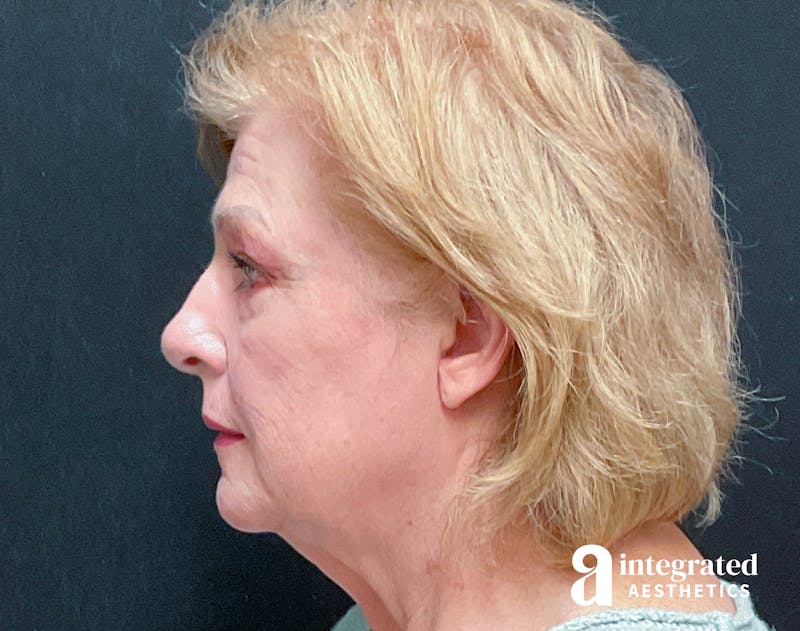 Facelift & Neck Lift Before & After Gallery - Patient 133212879 - Image 7