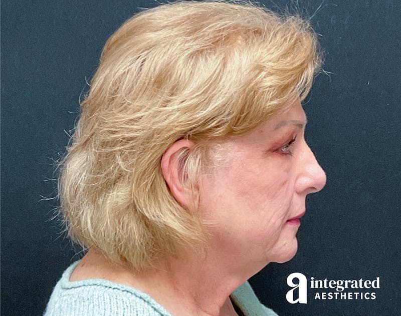 Facelift & Neck Lift Before & After Gallery - Patient 133212879 - Image 9