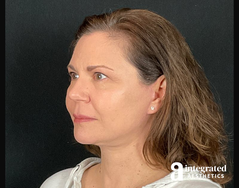 Facelift & Neck Lift Before & After Gallery - Patient 133212893 - Image 6