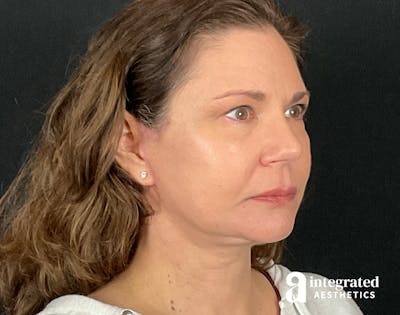 Facelift & Neck Lift Before & After Gallery - Patient 133212893 - Image 2
