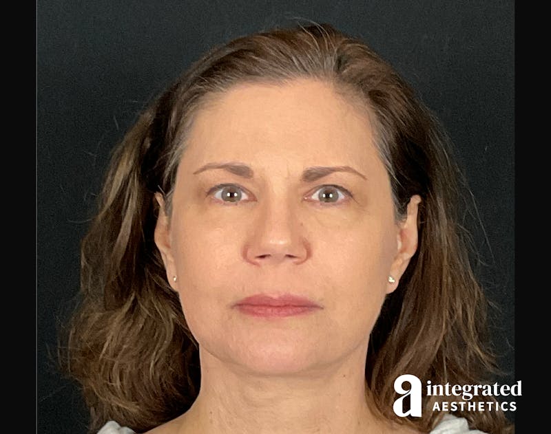 Facelift & Neck Lift Before & After Gallery - Patient 133212893 - Image 4